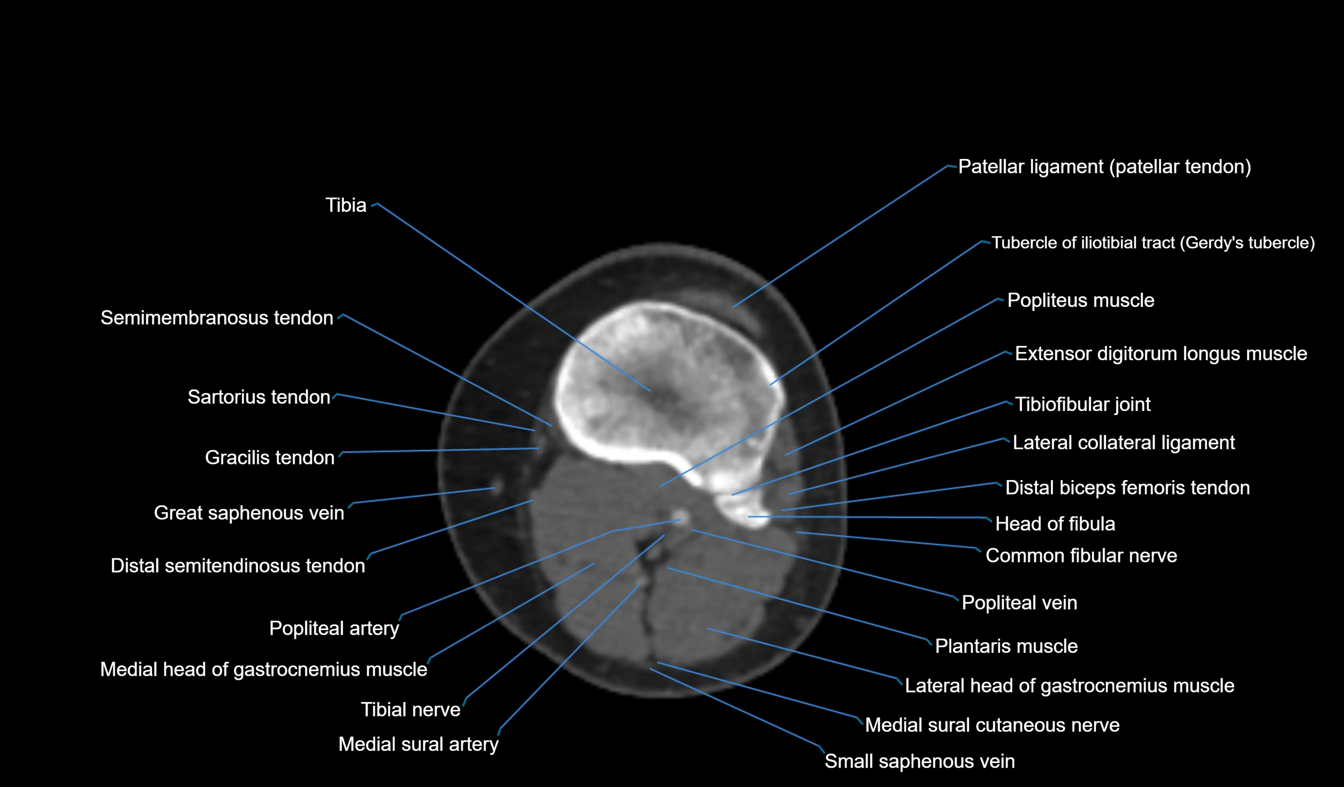 CT knee axial cross sectional anatomy labelled image-00043.webp